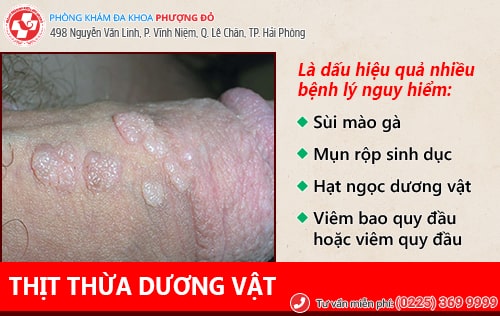 Nam giới cần cảnh giác với thịt thừa dương vật