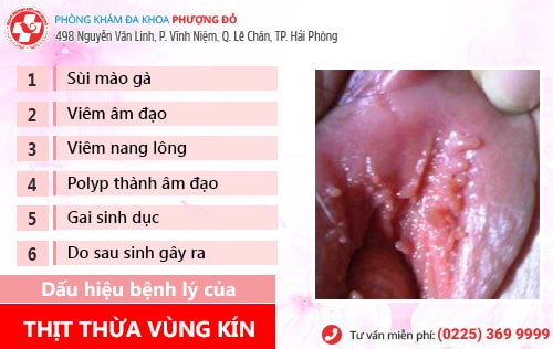 thịt thừa vùng kín