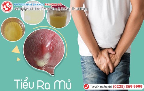 Tiểu ra mủ do mắc bệnh lậu