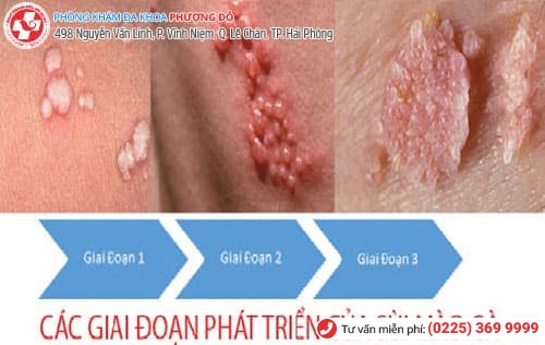 triệu chứng bệnh sùi mào gà