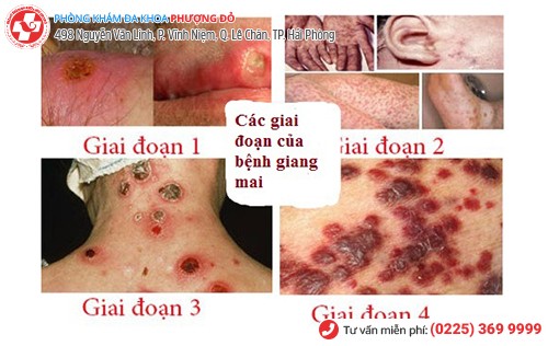 Các giai đoạn bệnh giang mai ở nam giới