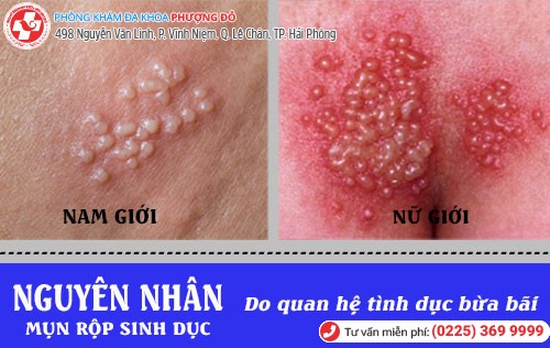 Mụn rộp sinh dục ở nam và nữ