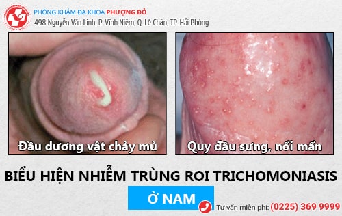 Biểu hiện nhiễm Trichomonas ở nam giới