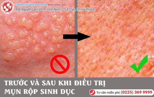 Kết quả sau khi hỗ trợ điều trị mụn rộp sinh dục