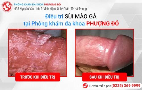 Hình ảnh trước và sau khi điều trị sùi mào gà 