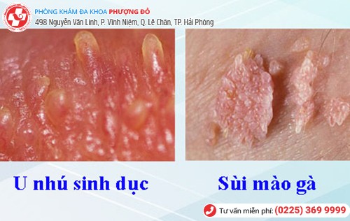 Phân biệt u nhú sinh dục và sùi mào gà