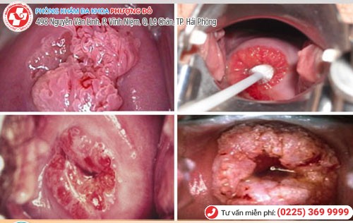 Ung thư cổ tử cung do sùi mào gà