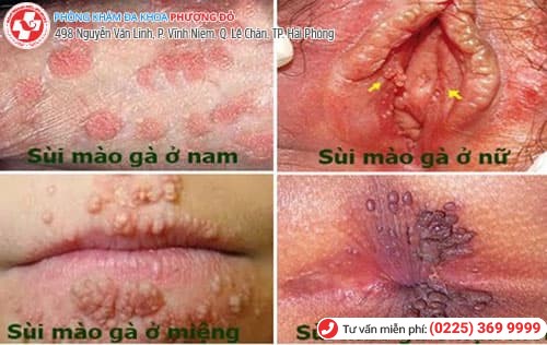 vị trí sùi mào gà