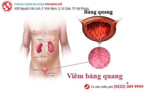 Hình ảnh viêm bàng quang