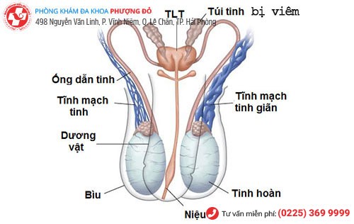 Hình ảnh túi tinh bị viêm