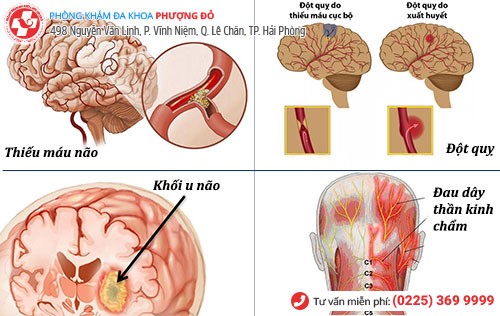 nguyên nhân đau đầu bên phải